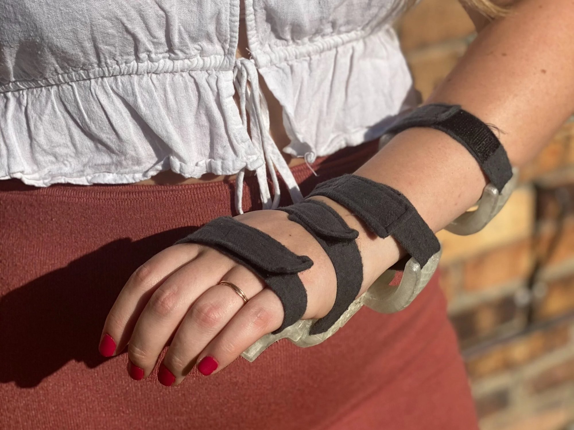 The cast applied to a patient suffering from a wrist fracture
